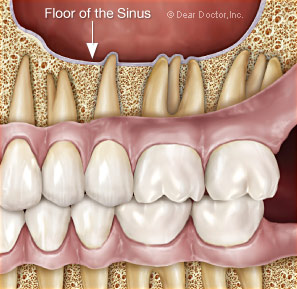 What Is The Connections With My Sinuses & My Teeth? – CrimsonCare