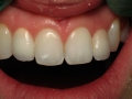 Patient 2 - After
