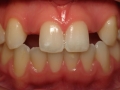 Patient 2 - Before