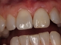 Patient 1 - After