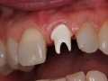 Patient 1 - Before