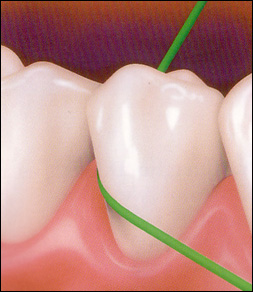 flossing-teeth