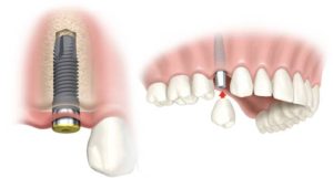 dental-implant-beverly-hills