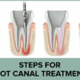 Do You Need A Root Canal?