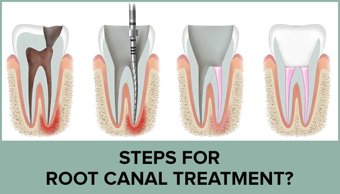 Do You Need A Root Canal CrimsonCare Family Dental